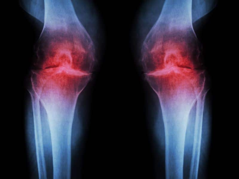 radiografía de rodillas con artrosis